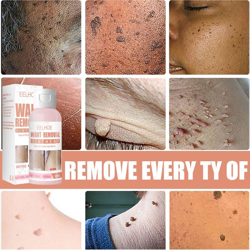 Skin Tag Remiving Cream DUbai